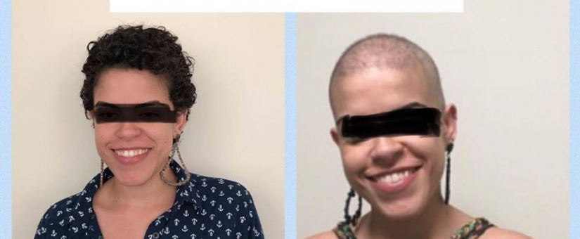 Patientin, Alopecia Universalis, 02/2019 (Brasilien)